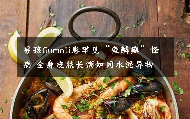 男孩Gumoli患罕见“鱼鳞癣”怪病 全身皮肤长满如同水泥异物