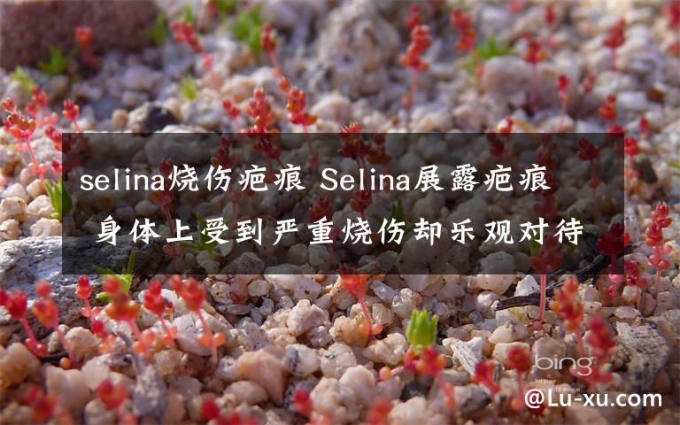 selina烧伤疤痕 Selina展露疤痕 身体上受到严重烧伤却乐观对待