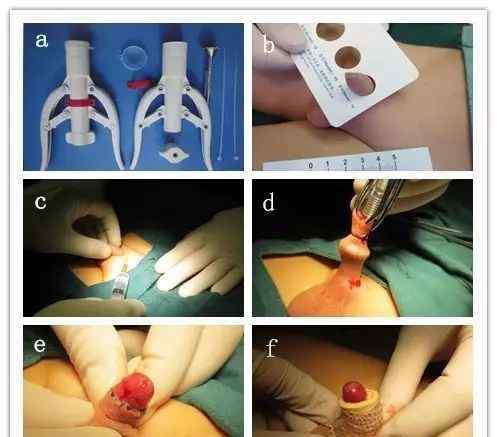 幼儿包茎的图片 儿童包皮环切术手术过程