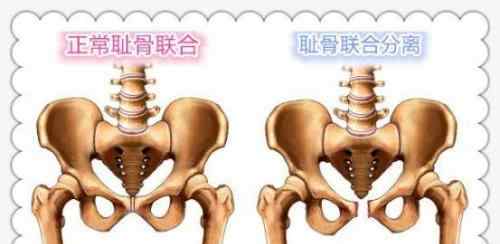 耻骨疼 多么痛的领悟——耻骨联合分离疼痛