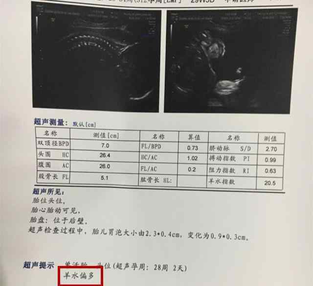 羊水太多也不好?怀孕期间“羊水偏多”有风险性,孕妈妈提早掌握