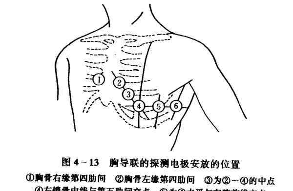 心电图导联位置颜色 【图】心电图导联位置图解大全 心电图导联连接快速确定位置