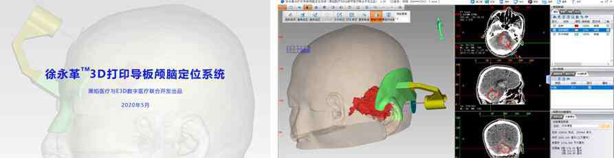 徐永革 3D打印导板辅助脑出血微创手术    黑焰与徐永革团队助力基层医院