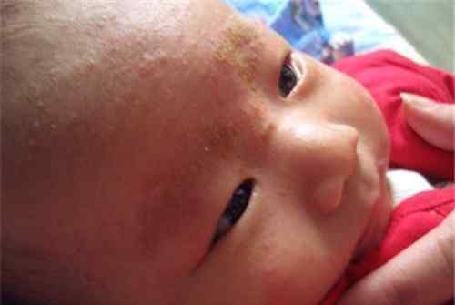 新生儿湿疹用什么药 婴儿干性湿疹怎么护理 干性湿疹用什么药好