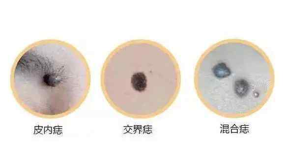 痦子和痣的区别 吉痣和恶痣的区别特征