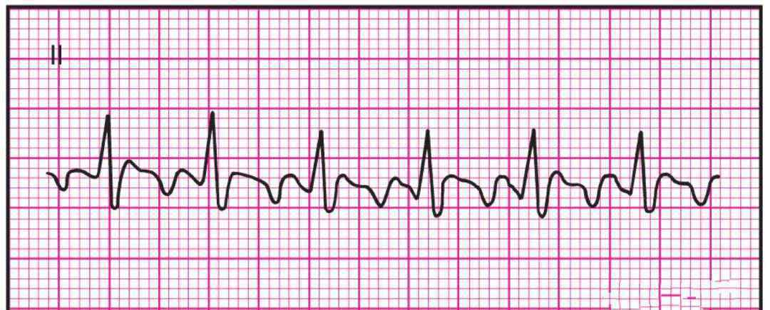 体表心电图具有"锯齿"特征,avf常出现f波;房室比为2:1时,心室率