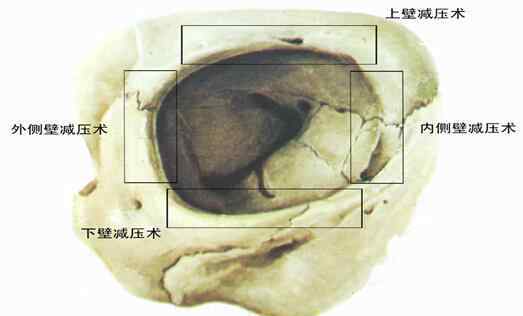 眼球突出治疗 夏氏EPS突眼矫正术——突眼症患者的福音