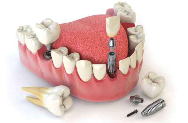 牙医不建议亲属种牙 有没有人做过种植牙，能谈一谈感受吗？我种有5颗，说一下