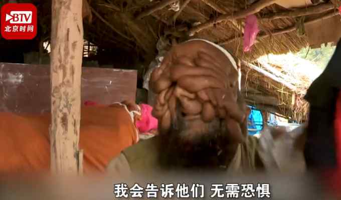 “大家都叫我无脸男”！印度一男子满脸肉瘤 曾险被当野兽枪杀