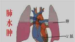 肺水肿是怎么引起的 新生儿肺水肿是怎么造成的？