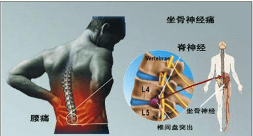 腰肌劳损怎样缓解，最佳的治疗方法是什么？