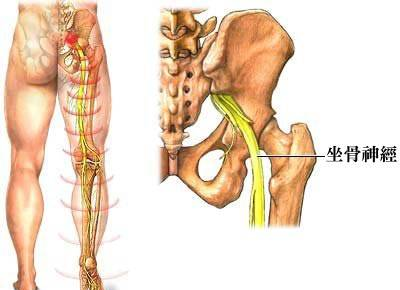 你知道吗？其实“坐骨神经痛”只是一种症状，不是病！