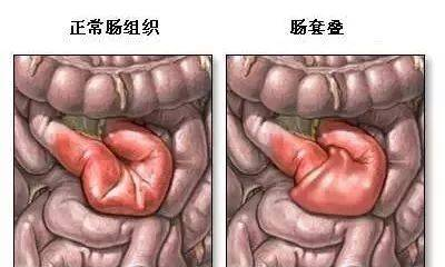 四种治疗肠梗阻的有效方法