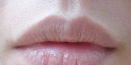 嘴唇起皮是什么原因?