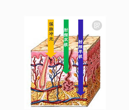 拉皮一次多少钱，拉皮的费用，拉皮术除皱无力吐槽！！