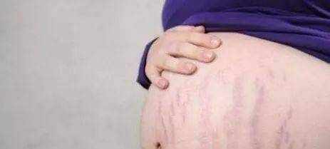 几个方法告诉宝妈们，教你如何预防妊娠纹？