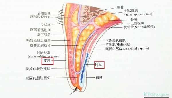 埋线双眼皮必看扫盲帖