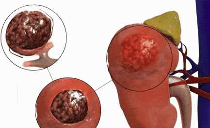 肾癌的早期症状，常腰痛的要小心了！