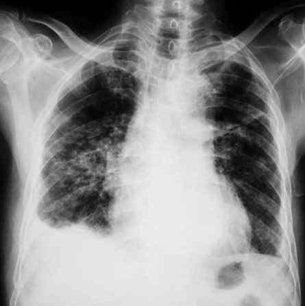 肺感染老人去世前表现 单田芳、杨绛等多位名人因肺部感染去世 警惕这几个症状