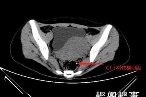 尹慧敏 近日,一女子以为自己患了疾病便胡乱买药治疗却未见好转,再到医院一查医生都懵了