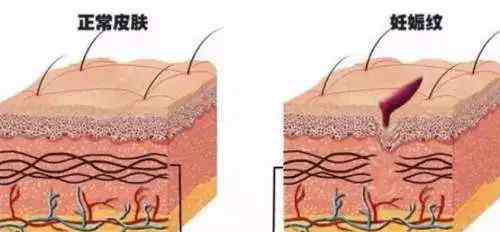 妊娠纹怎么预防 80%的妈妈都会遇到！孕期妊娠纹怎么预防？