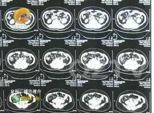 男人怀孕肚子越来越大 福建一男子腹部隆起似“怀孕” 原来体内长有4个肾