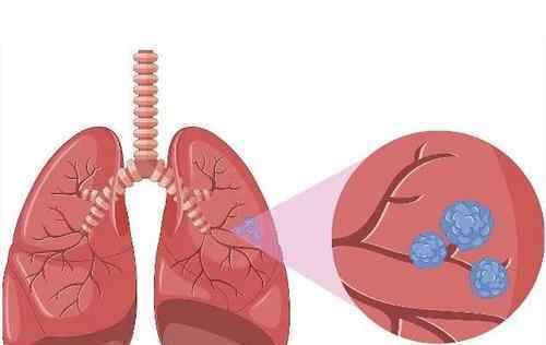 肺结节是怎么引起的 “肺部小结节”是肺癌的前兆？看完你就清楚了……