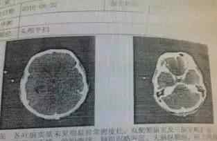 男子被吃脑虫入侵 男子被罕见的“吃脑虫”入侵 十几天后病逝