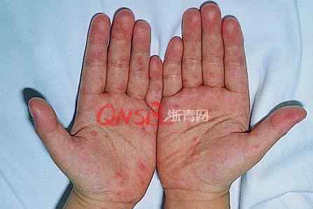 杭州儿童指甲断裂 杭州4岁男孩手指甲突然间脱落 之前得过这种病