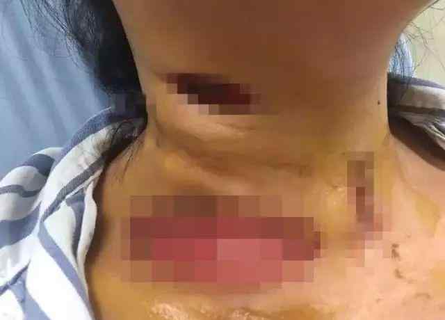 食肉菌 40岁女子感染“食肉菌” 颈部被“吃”出个大洞