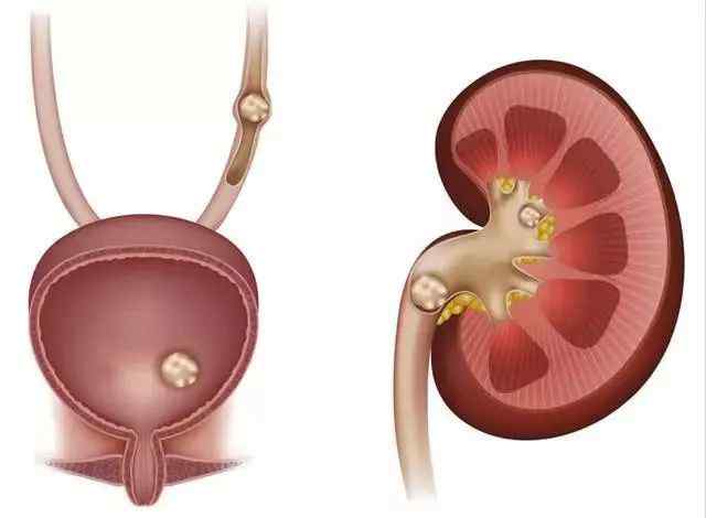 1cm 肾结石不可怕，当肾结石大于1cm就得当心了！