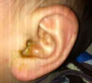 外耳炎 中耳炎和外耳炎有什么区别？