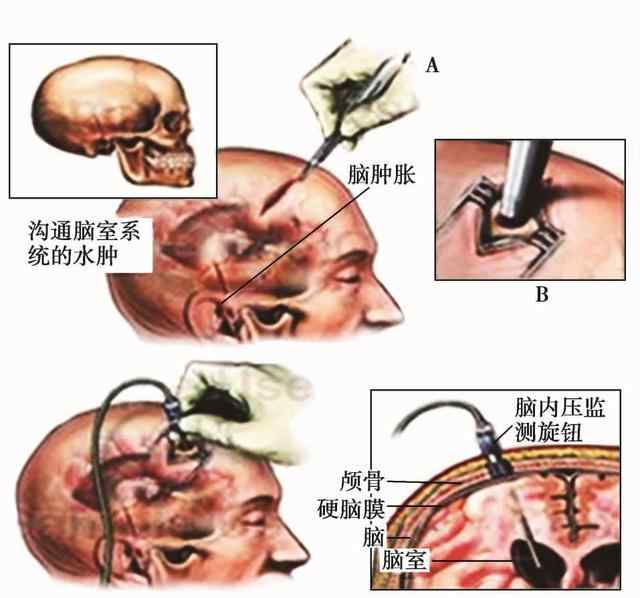 颅压高自己如何检测 颅内压监测的方法之有创ICP监测