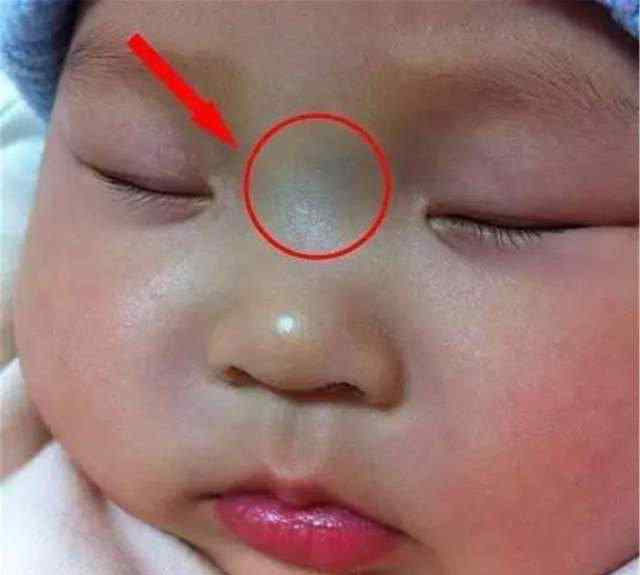 婴儿鼻梁上有青筋是怎么回事 “青筋过鼻梁，无事哭三场”这样的孩子脾气差、脾胃虚？别轻信