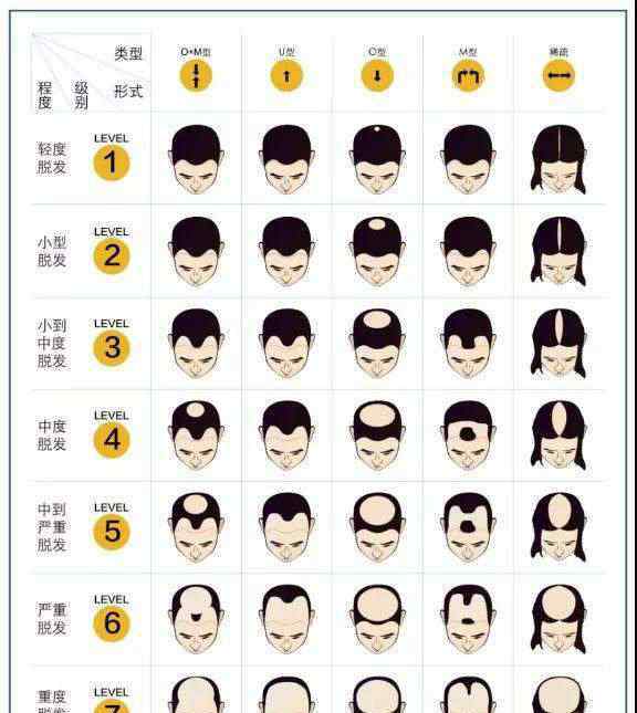 植发新闻 中国有2.5亿人脱发，有些“植发医生”花几千就能赚几百万
