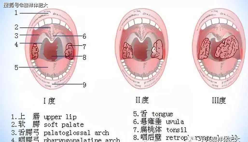 正常扁桃体和发炎图片 扁桃体状态图解 及 扁桃体发炎吃什么好？