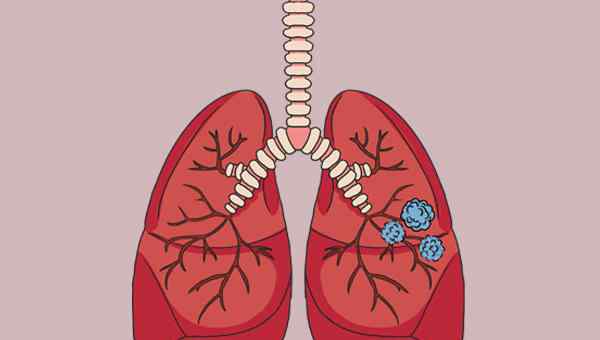肺部小结节会消失吗 肺结节会不会自动消失？查出肺结节，到底该如何处理？