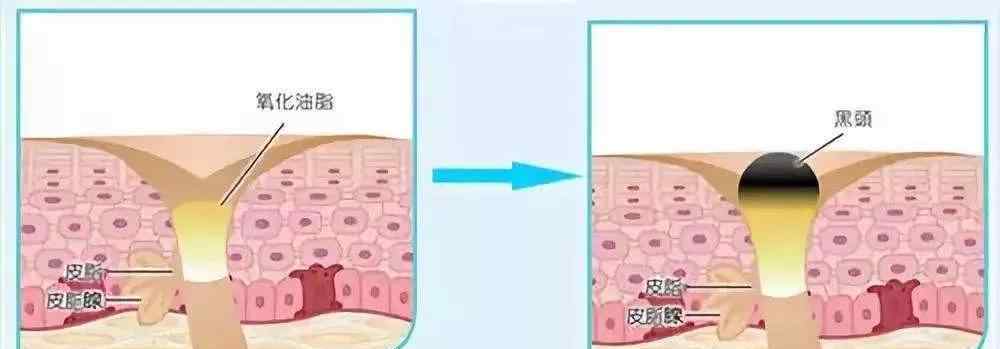 黑头怎么治 黑头太多怎么办？