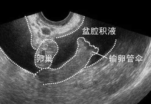 病理性盆腔积液 盆腔有积液是不是大问题？需要马上治疗吗？