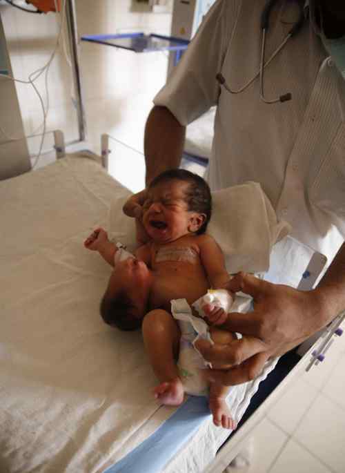 孕妇生出怪胎：印度女子产下双头“畸形”宝宝