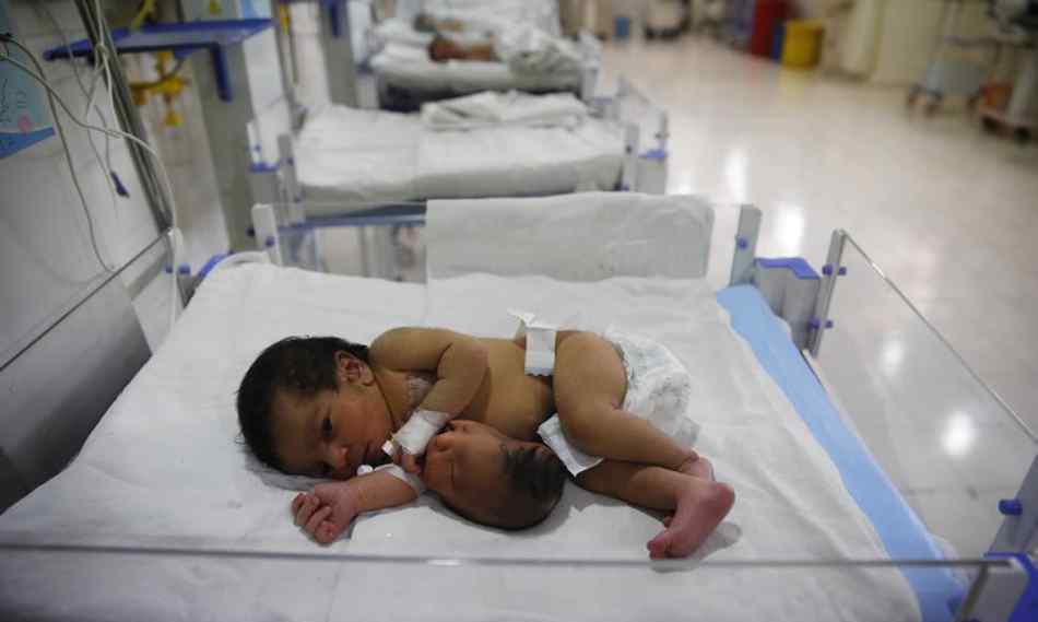 孕妇生出怪胎：印度女子产下双头“畸形”宝宝