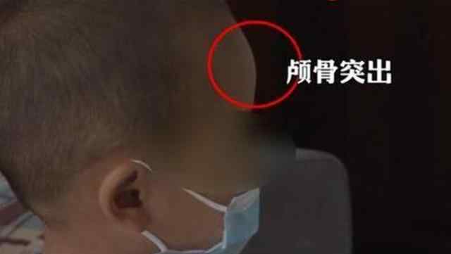 三鹿婴幼儿奶粉事件 “大头娃娃”再现，堪比12年前的三鹿奶粉事件，网友：实在无法原谅