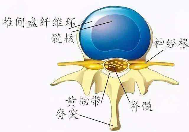 腰椎间盘突出人工腰椎 腰椎间盘突出80%-90%不需要手术，可以这样治....