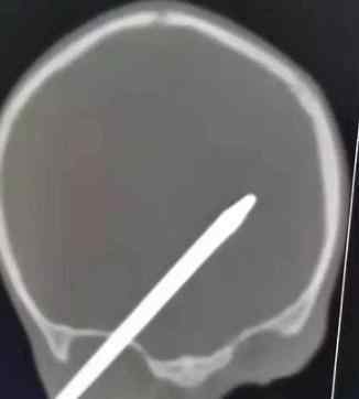 医生10秒拔大脑钢针 2岁男童脑部插入钢针事件详情是