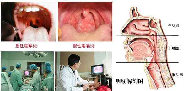 慢性咽炎雾化治疗 慢性咽炎很顽固，千万不要大意