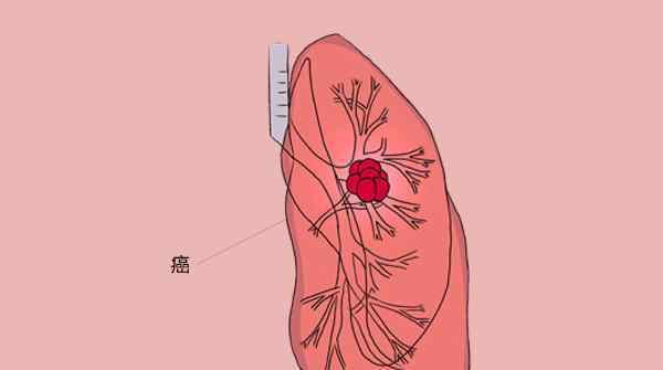 肺癌的咳嗽特点 咳嗽是小病？呼吸科医生：满足3个特点，也许是肺癌的征兆