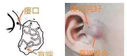 耳前瘘管感染 什么是先天性耳前瘘管？
