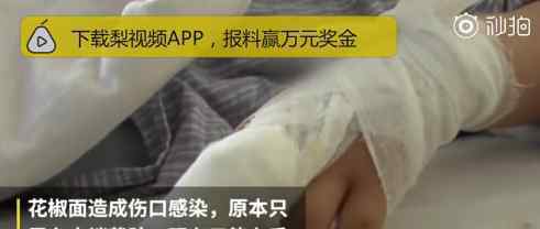 奶奶用花椒面给孙女止血感染截肢 网友:科普道阻且长