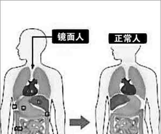 温州男子五脏六腑反着长 发生概率只有百万分之一