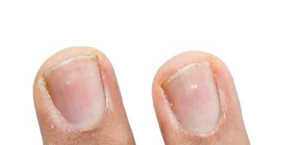 长出来的指甲是乳白色 指甲出现这4个现象，不要忽视，可能是大病的先兆